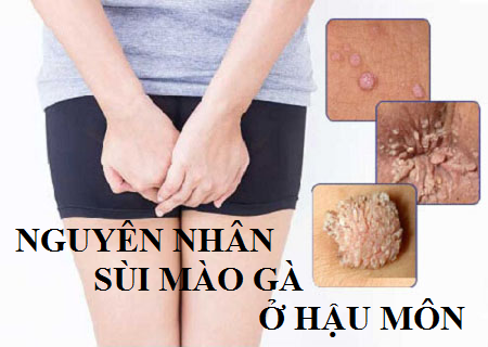 3 nguyên nhân mọc sùi mào gà ở hậu môn