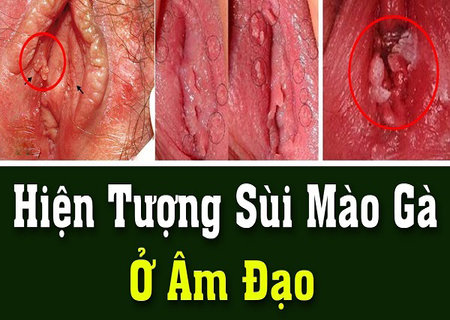 5 dấu hiệu mọc sùi mào gà âm đạo