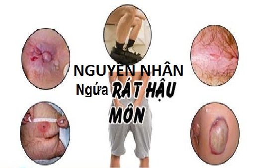 5 nguyên nhân vì sao bị ngứa rát hậu môn