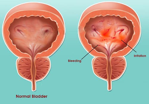 Bệnh viêm bàng quang là gì?