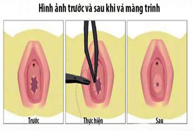 Vá́ màng trinh có ảnh hưởng gì không?