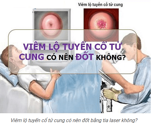 VIEM-LO-TUYEN-CO-NEN-DOT-KHONG