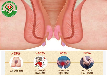 Các triệu chứng bệnh trĩ hỗn hợp