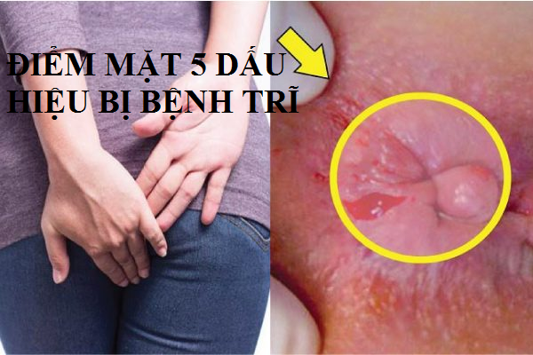 Điểm mặt 5 dấu hiệu bị bệnh trĩ