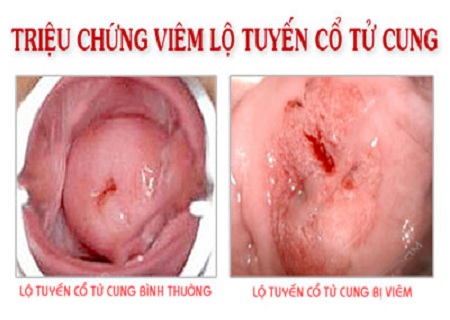 lo-tuyen-chay-mau