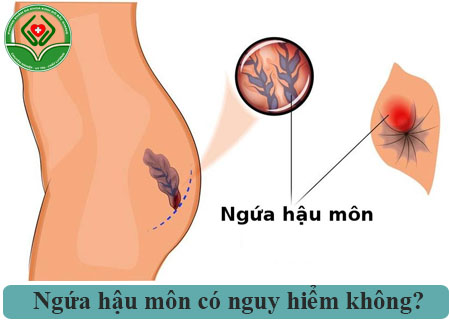 Ngứa hậu môn nguy hiểm như thế nào