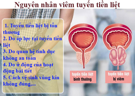 Các nguyên nhân gây viêm tuyến tiền liệt