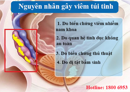 4 thủ phạm chính gây viêm túi tinh