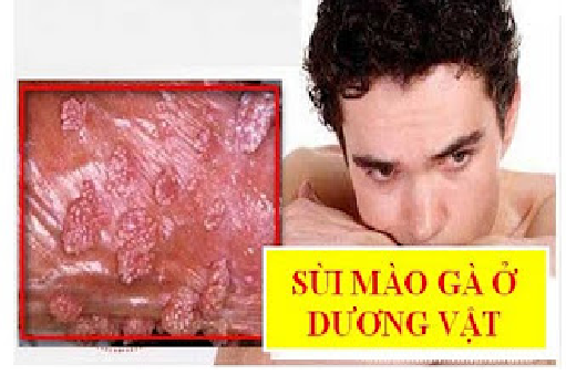 Sùi mào gà ở dương vật đừng chủ quan