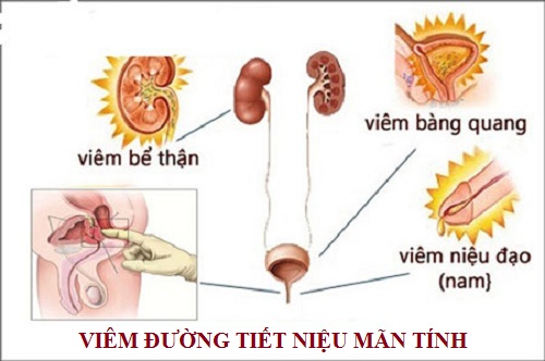 Viêm tiết niệu mãn tính nguy hiểm khôn lường