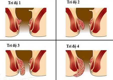 ĐÂU LÀ PHƯƠNG PHÁP CHỮA BỆNH TRĨ GIAI ĐOẠN 3 KHÔNG GÂY ĐAU ĐỚN?