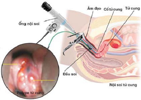 Nội soi âm đạo, cổ tử cung có đau không? Có ảnh hưởng gì không?