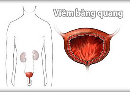 Viêm nhiễm đường tiết niệu dưới