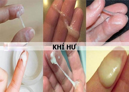 Hướng dẫn nhận biết bệnh phụ khoa qua khí hư