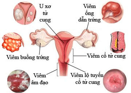 Bệnh viêm nhiễm vùng kín đừng chủ quan