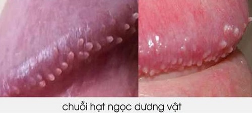 Bị chuỗi hạt ngọc dương vật