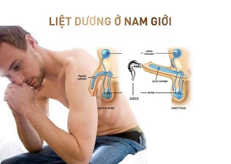 MÁCH BẠN PHƯƠNG PHÁP CHỮA BỆNH LIỆT DƯƠNG HIỆU QUẢ NHẤT HIỆN NAY