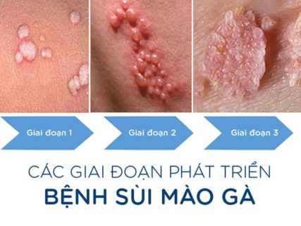 Sùi mào gà ở vùng kín