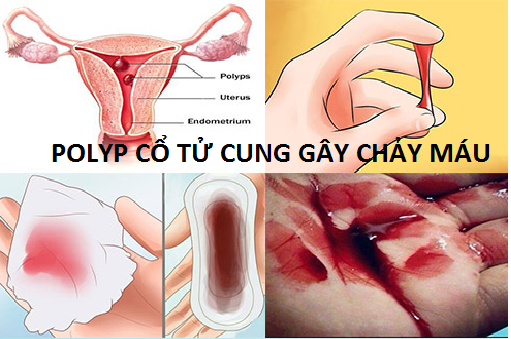 Cảnh giác polyp cổ tử cung gây chảy máu