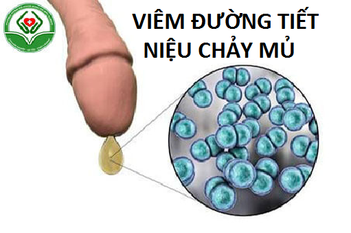 Cảnh giác viêm đường tiết niệu chảy mủ