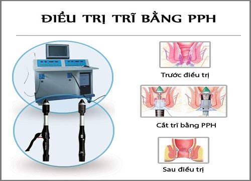 Cắt trĩ bằng phương pháp PPH liệu có an toàn không?