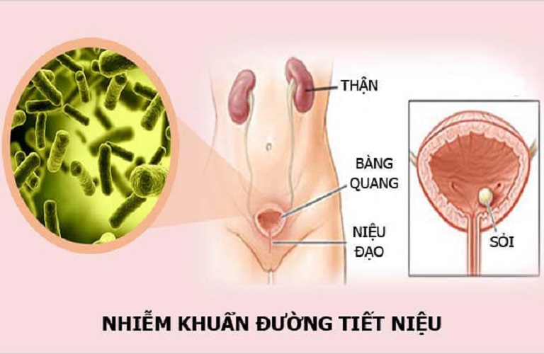 Viêm nhiễm đường tiết niệu cấp