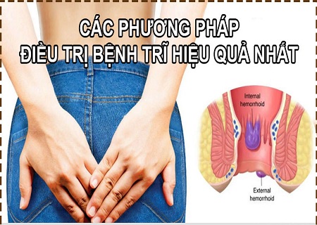 Phương pháp cắt trĩ nào không gây đau đơn?