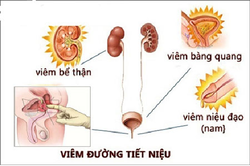 Tìm hiểu bệnh viêm đường tiết niệu