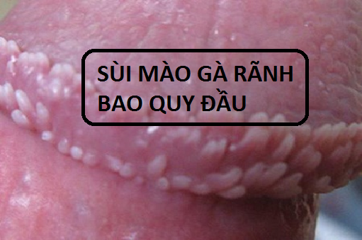 Tình trạng sùi mào gà rãnh quy đầu