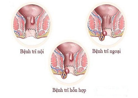 Bệnh trĩ hỗn hợp là gì? Cách điều trị d.ứt đ.iểm trĩ hỗn hợp