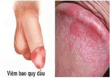 ĐAU DƯƠNG VẬT LÀ BIỂU HIỆN CỦA BỆNH GÌ?