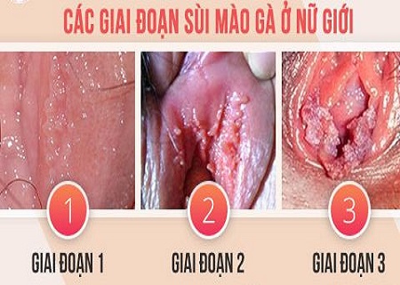 Sùi mào gà ở vùng kín