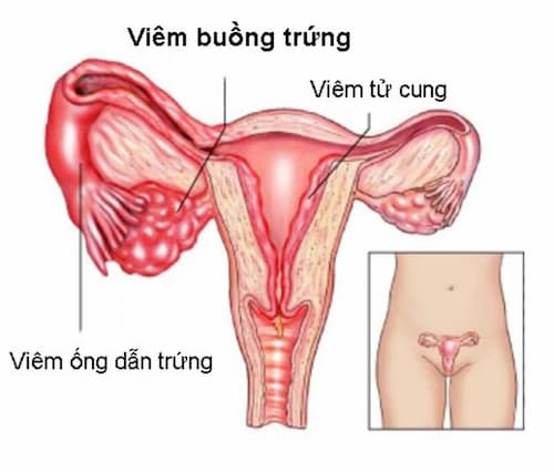 Viêm vòi trứng có mủ