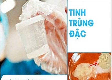 PHƯƠNG PHÁP CHỮA TINH TRÙNG ĐẶC HIỆU QUẢ HÀNG ĐẦU HIỆN NAY