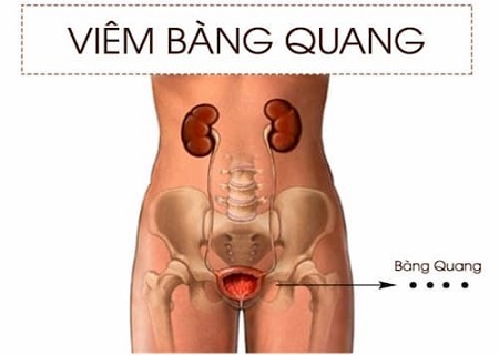 Triệu chứng của bệnh viêm bàng quang