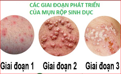 Các giai đoạn của mụn rộp sinh dục