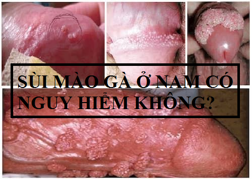 Cảnh báo sùi mào gà ở nam có nguy hiểm không