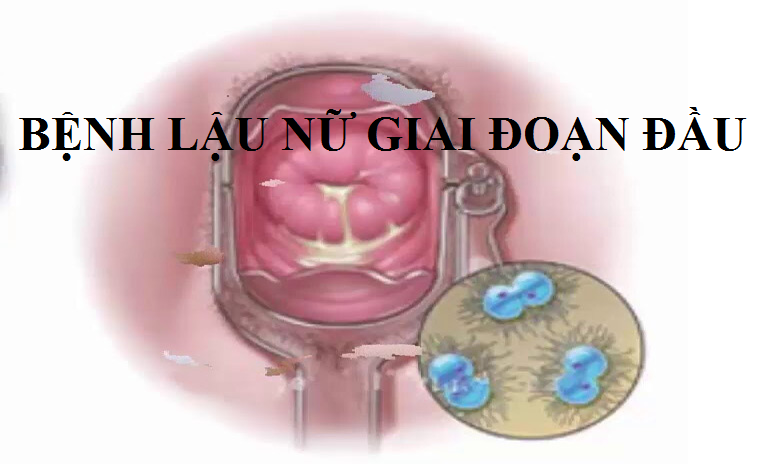 Cảnh giác lậu nữ giai đoạn đầu