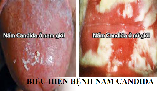 Chi tiết 5 biểu hiện bệnh nấm Candida