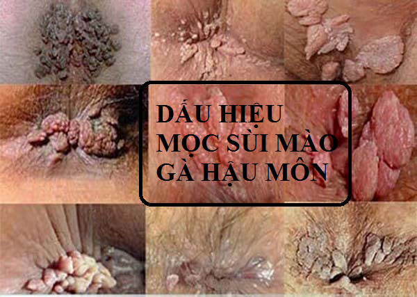 Dấu hiệu mọc sùi mào gà hậu môn