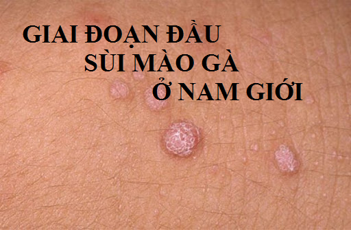 Đừng chủ quan giai đoạn đầu sùi mào gà ở nam