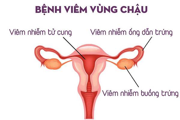 Bệnh viêm vùng chậu là gì?