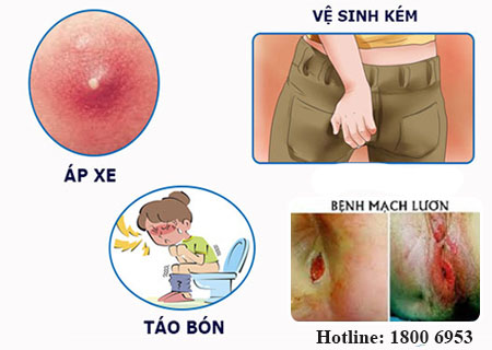 Các nguyên nhân dẫn đến bệnh mạch lươn