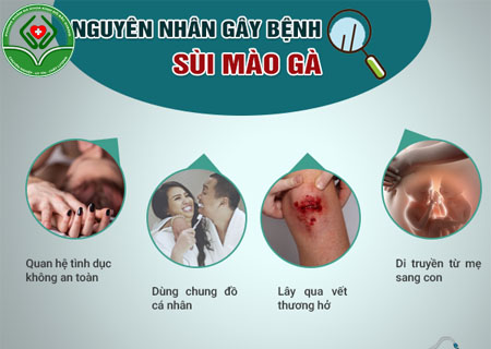 Sùi mào gà có nhiều nguyên nhân gây ra