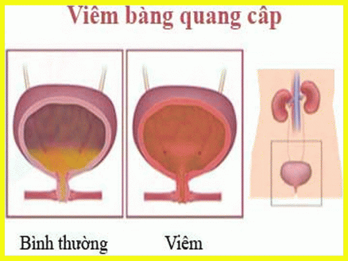 Viêm bàng quang cấp