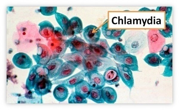 Bệnh chlamydia là gì?