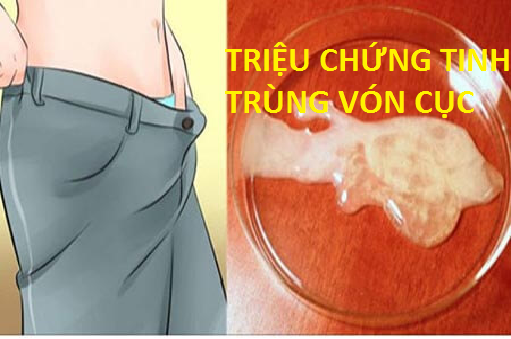 5 triệu chứng của bệnh tinh trùng vón cục