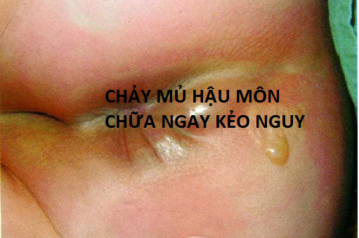 Hậu môn chảy mủ chữa ngay kẻo nguy