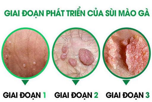 Dấu hiệu mọc sùi mào gà ở vùng kín